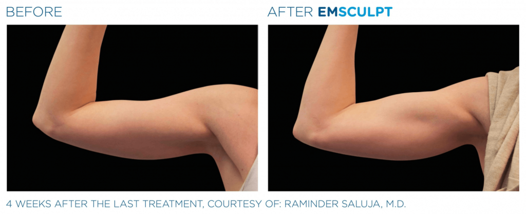 دستگاه ام اسکالپت Emsculpt عضله ساز و حجم دهنده باسن